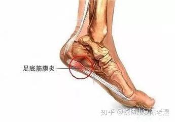 扁平足才懂的痛 足底筋膜炎 知乎