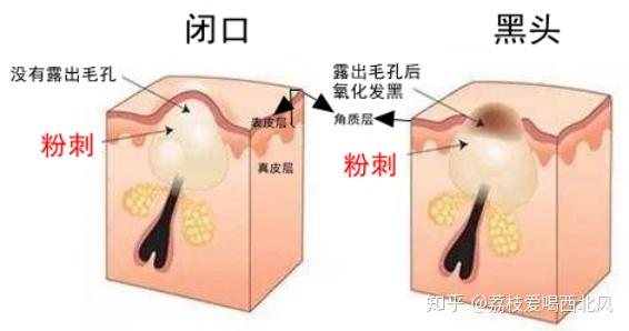怎样才能不长闭口粉刺 v2-1f32f0d1f7ff0732f0a04225bf4b686f_r.jpg