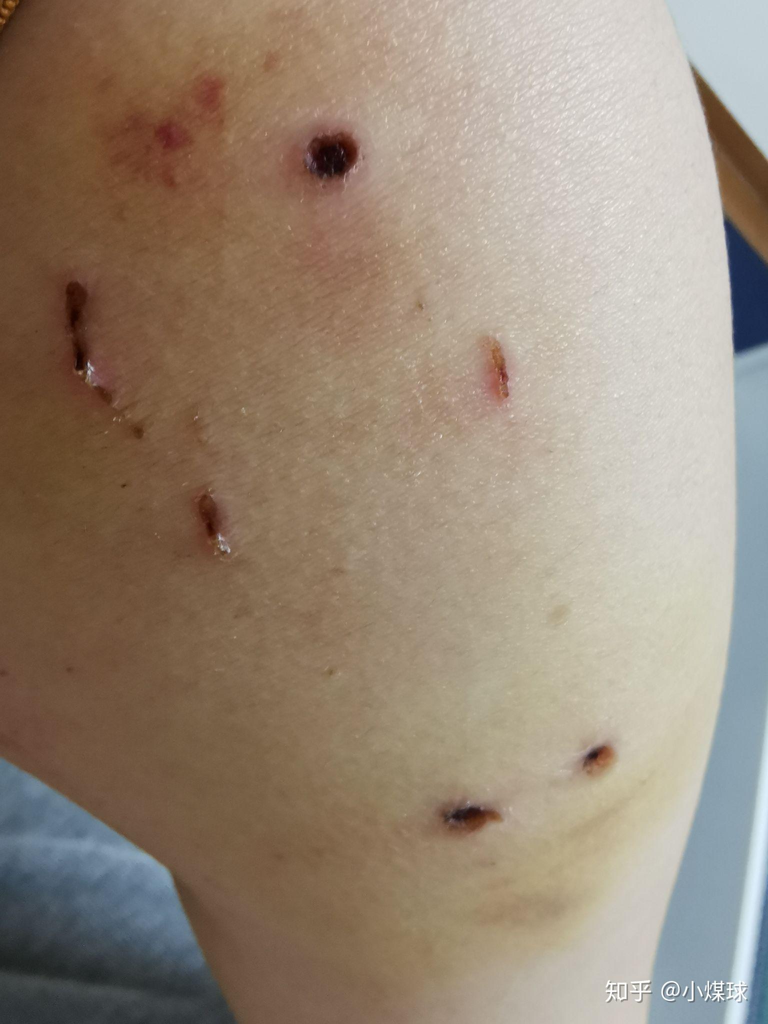 被加菲咬了记录伤口愈合过程哈