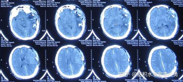 车祸脑外伤脑积水性脑膨出，外院7个月内4次住院脑积水脑膨出无改善，经李小勇治疗出院后正常的下田干农活 - 知乎