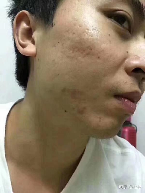 男生怎么祛痘去印男生长痘和撸有没有关系
