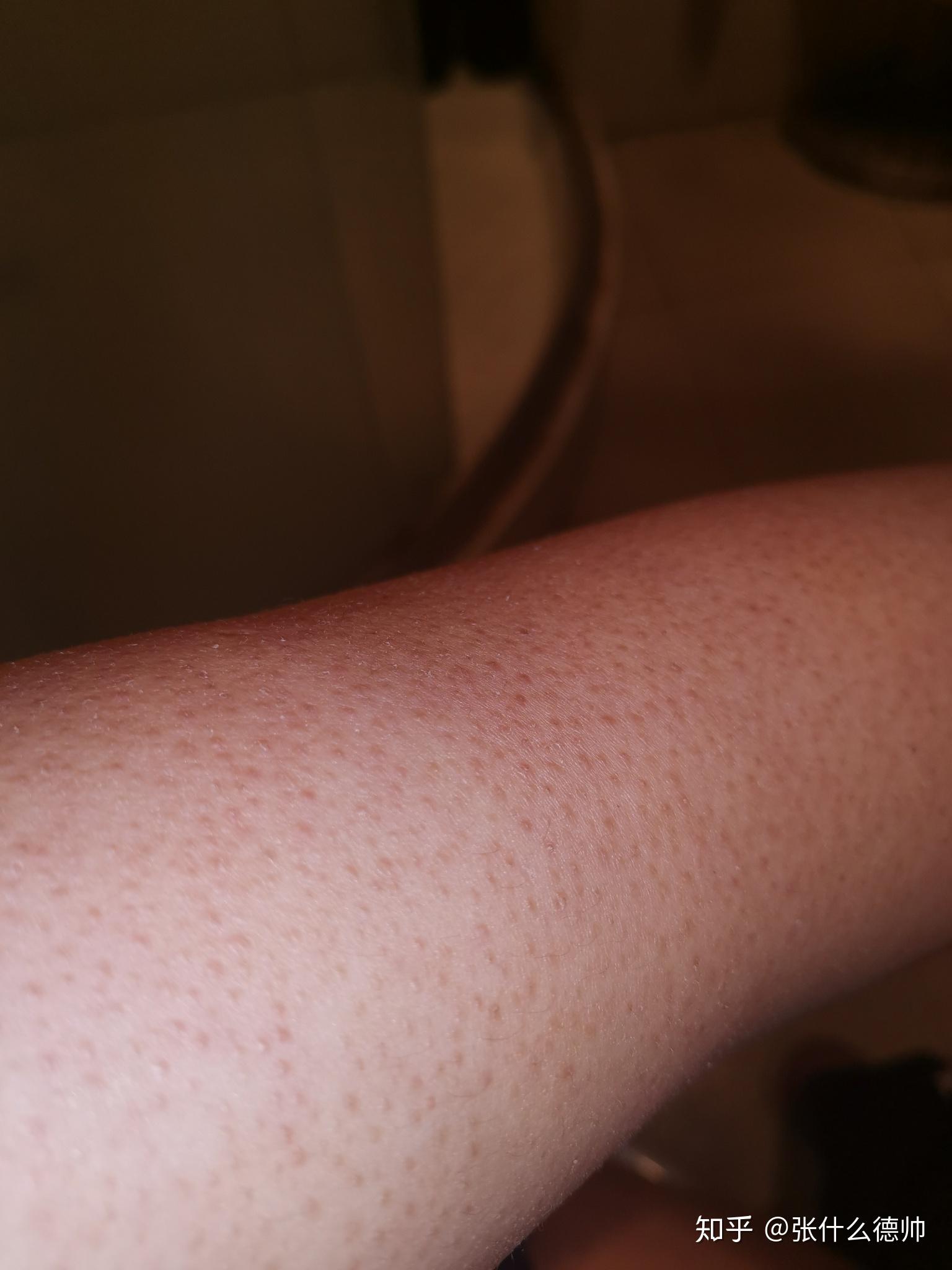 怎么能快速去掉鸡皮肤学生的简单介绍