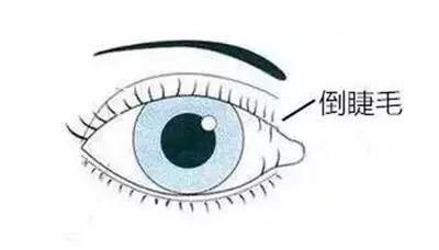 睫毛倒着长 倒睫 了解一下 知乎 睫毛倒着长 倒睫 了解一下 知乎