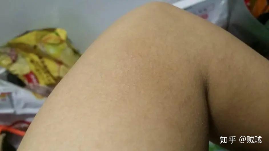乙醇爽肤水去鸡皮肤步骤的简单介绍