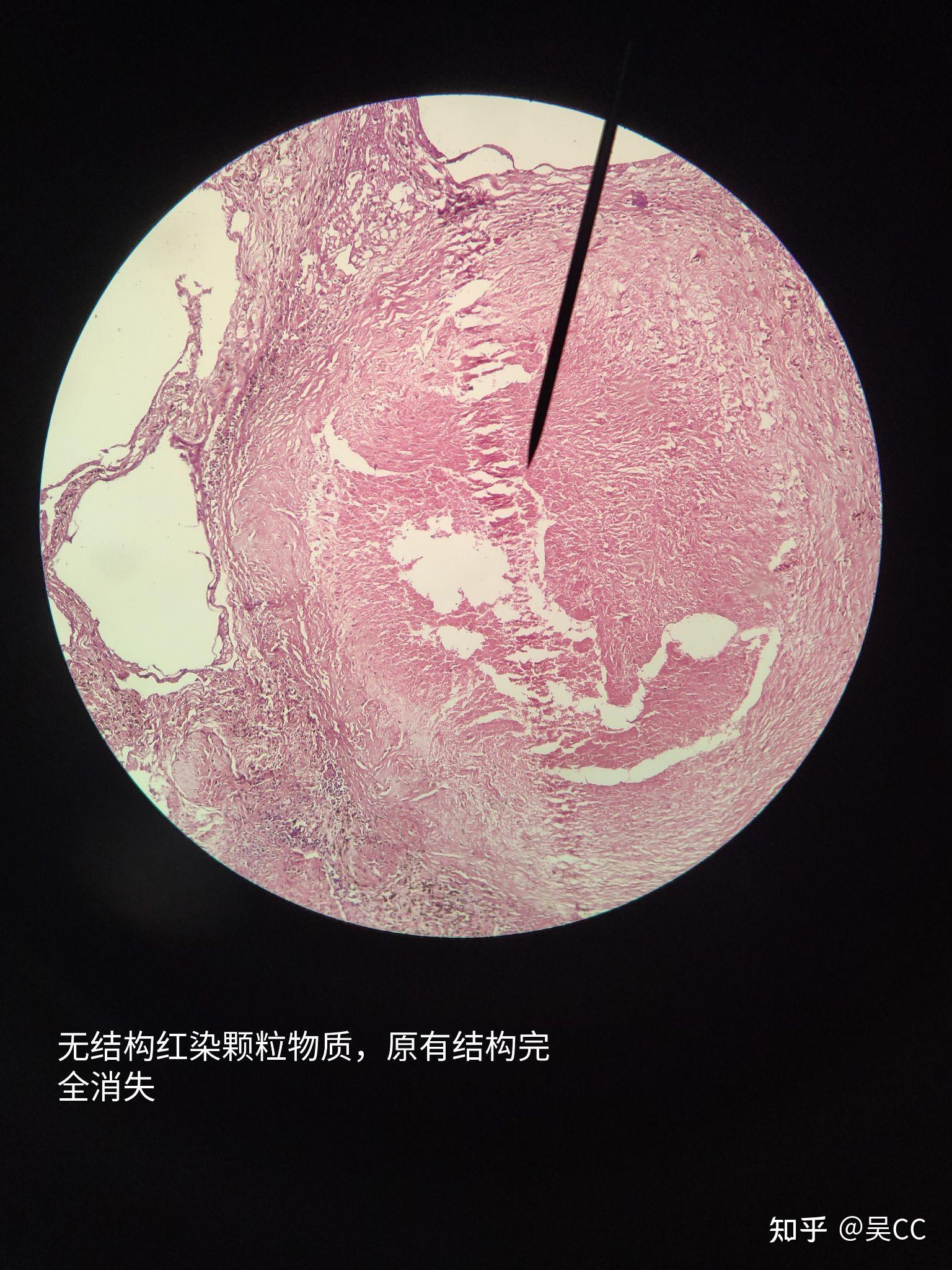 凝固性坏死图片干酪图片