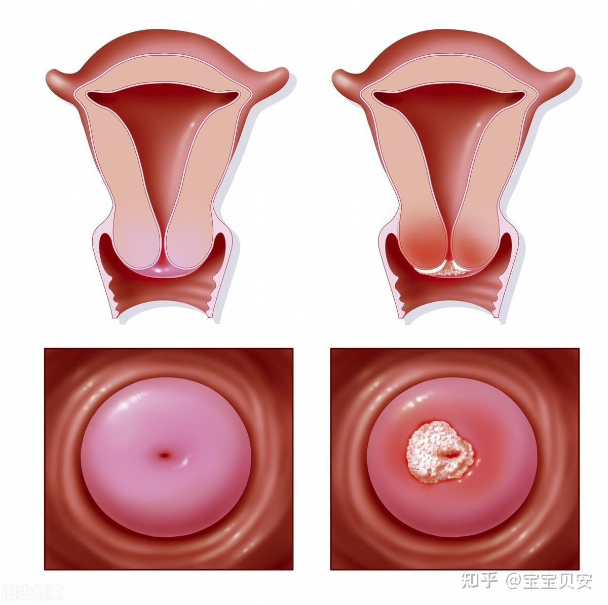 宮頸囊腫會發生癌變嗎? - 知乎