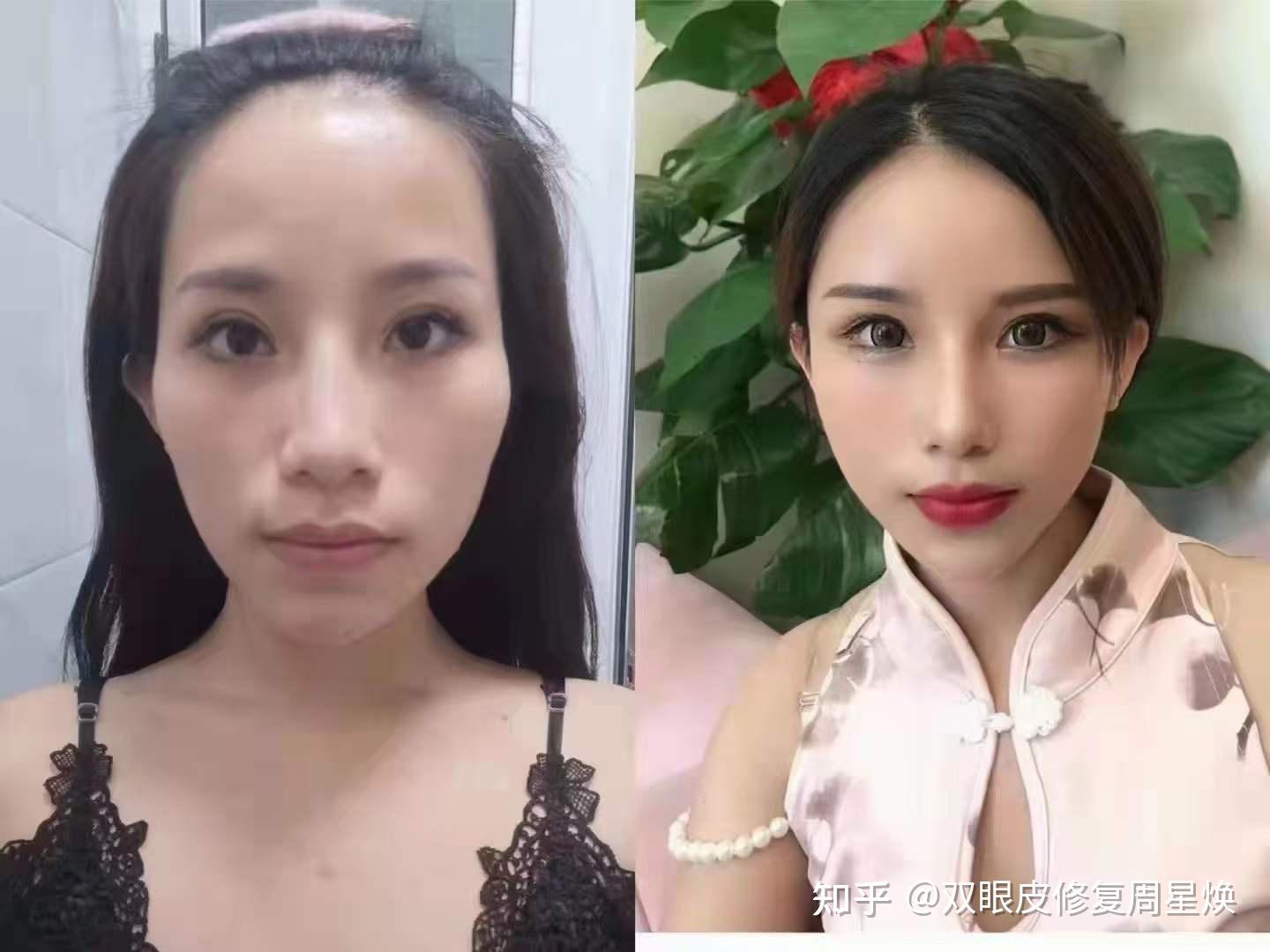 周星焕双眼皮修复面部脂肪填充可以给你带来那些改善