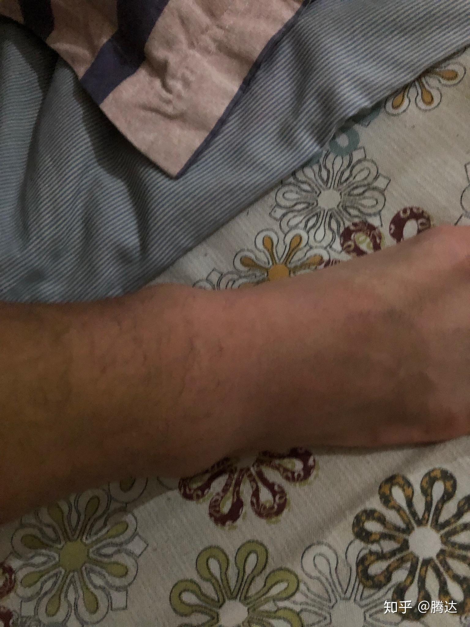 打篮球被垫脚两个月恢复中还没有消肿不能跳弯曲有限制怎么办什么时候