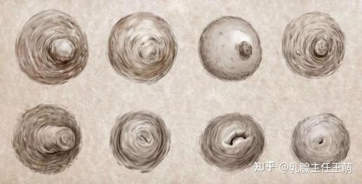 乳头内陷:潜藏的健康风险与矫正之道