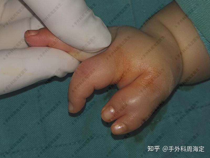 新生儿右手六指畸形父母四处寻医六指重构技术成功矫形