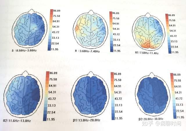 通过专家会诊,为瑞瑞安排了24小时动态脑电图检查,脑涨落等相关检查.
