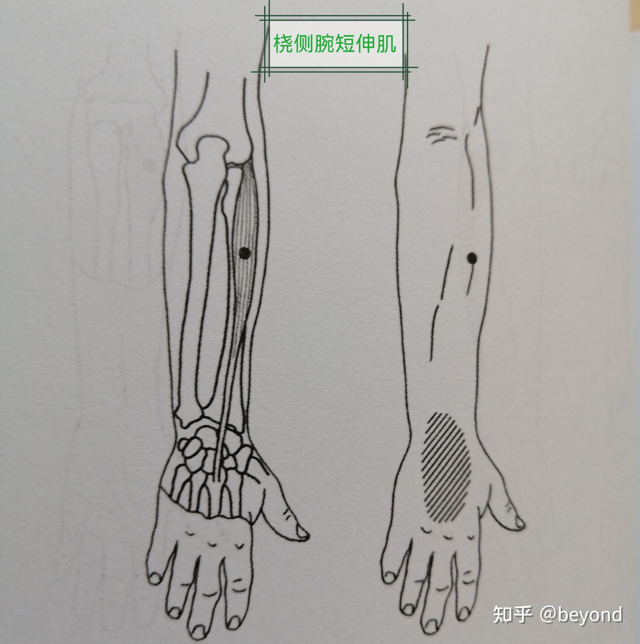 桡侧腕短伸肌将肱桡肌向外推,将肱桡肌下面的肌肉朝着桡骨用力按压,其