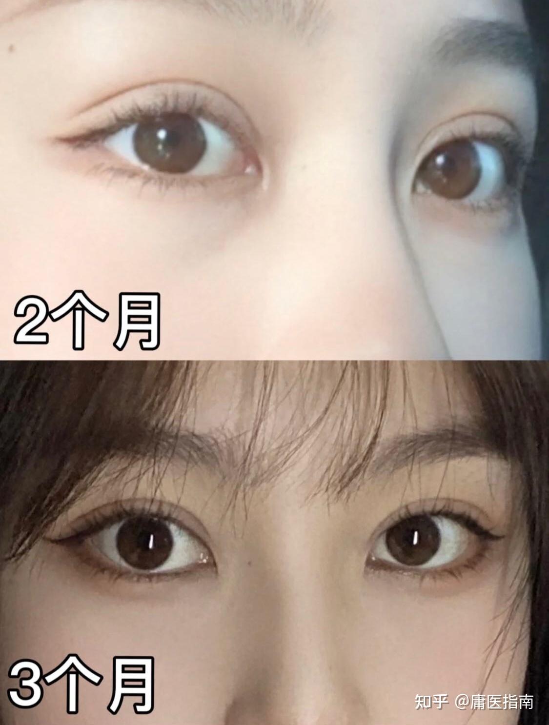 哪些人适合做宽双眼皮做多宽