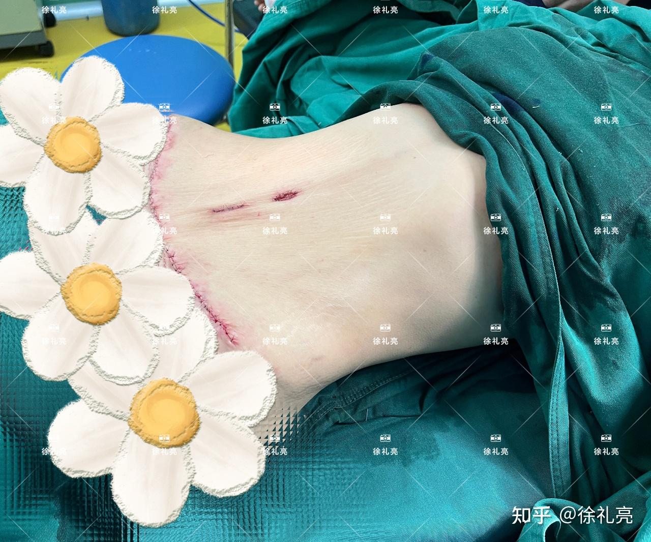 生完孩子肚皮软塌不成形皮肤严重松弛怎么办