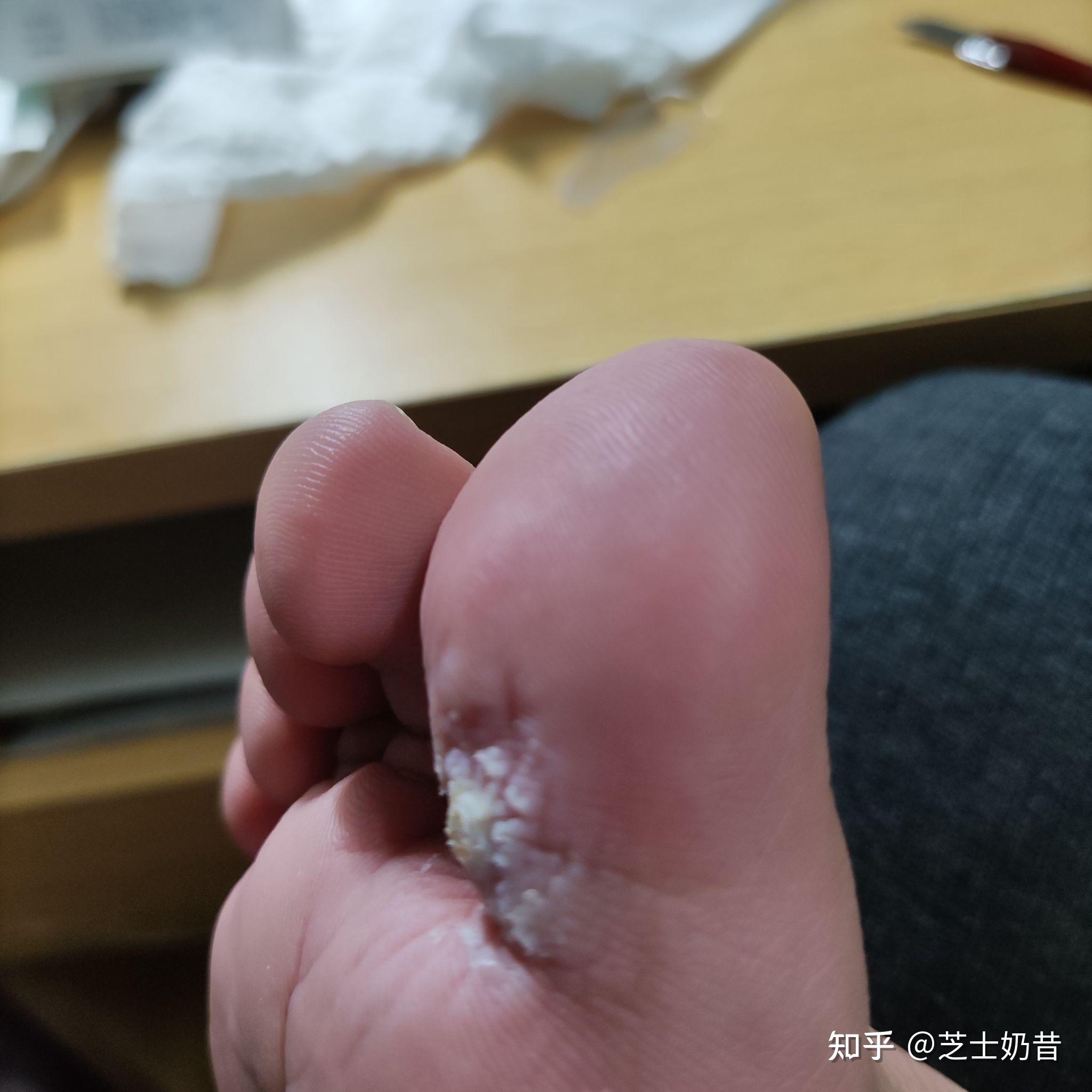 蹠疣的自治療過程