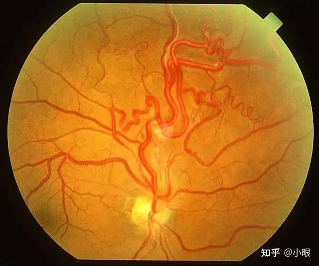 爱眼底|高血压导致眼内出现问题!这种疾病不容忽视!
