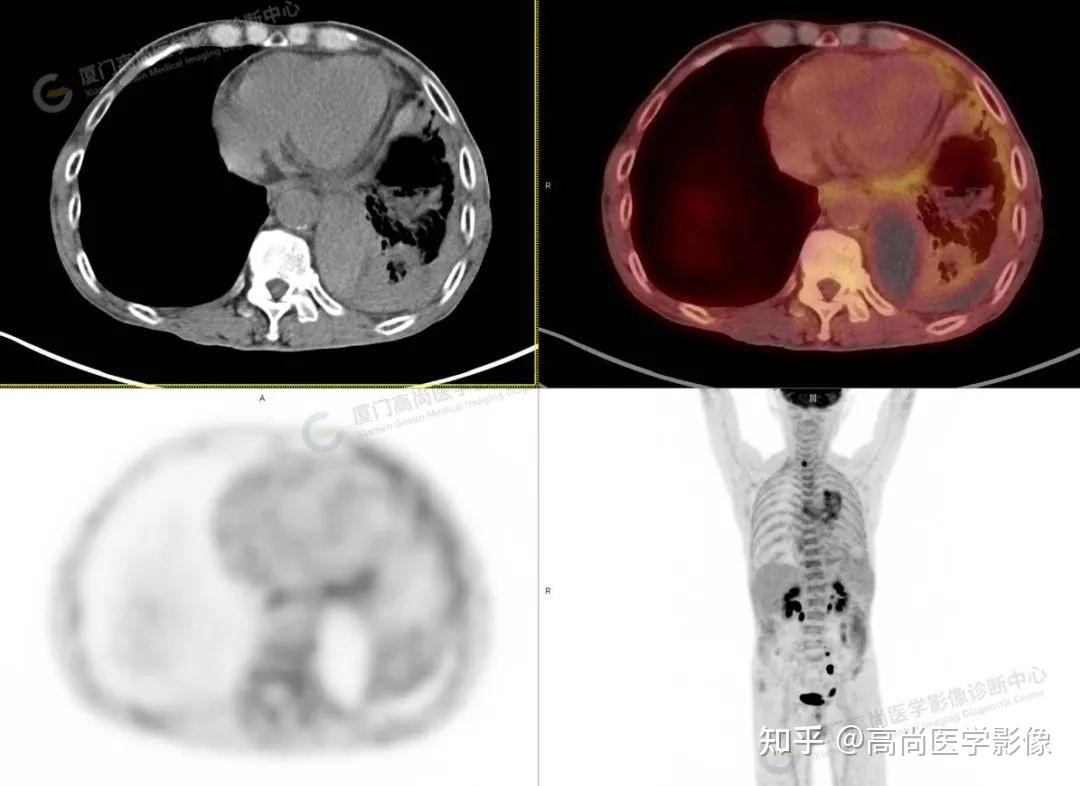CT和MRI如何看正常及异常冠状动脉，高清图谱请收好！_冠状动脉_CT_MRI_医脉通