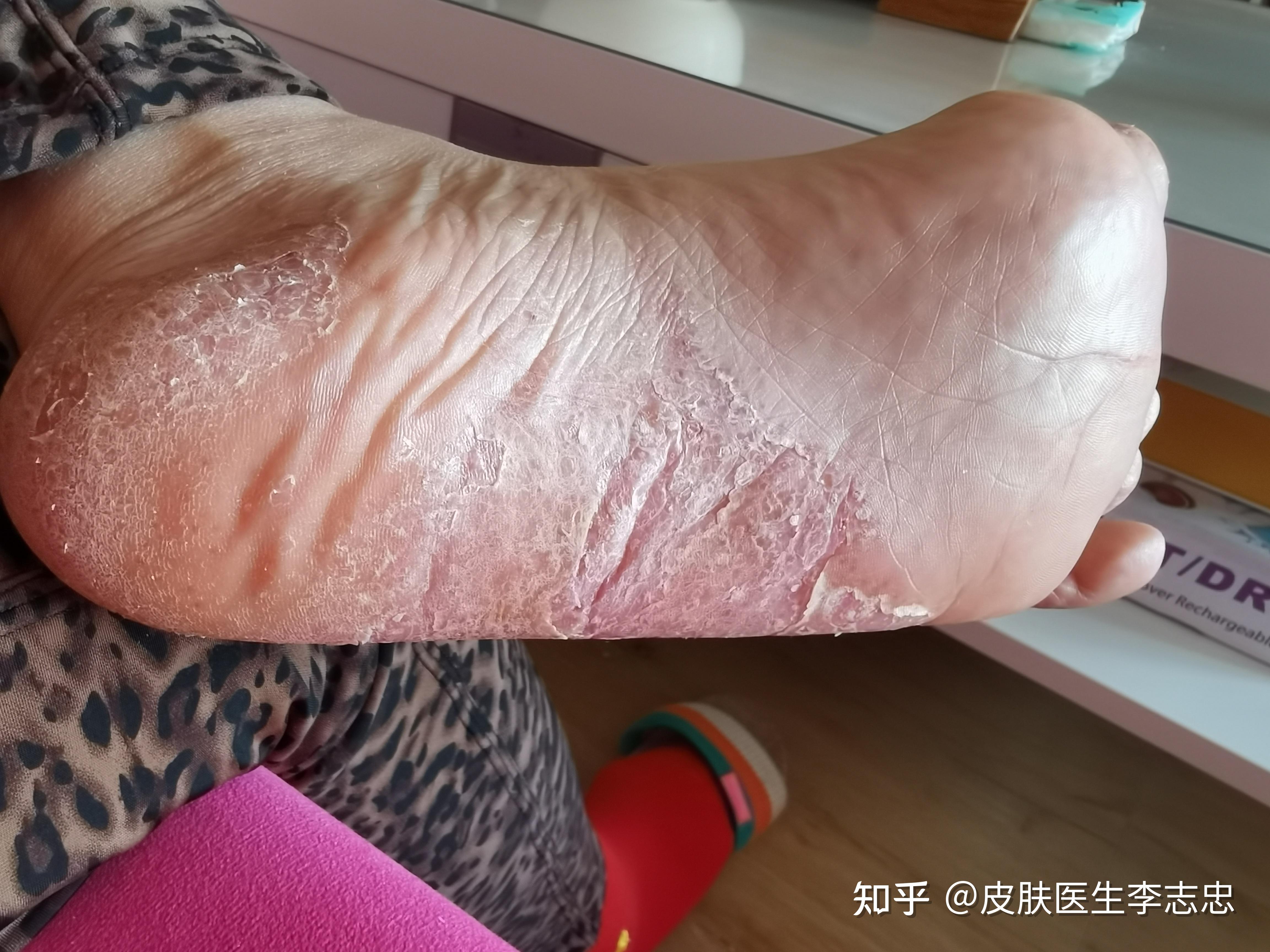 分享2个治掌跖脓疱病中医验方