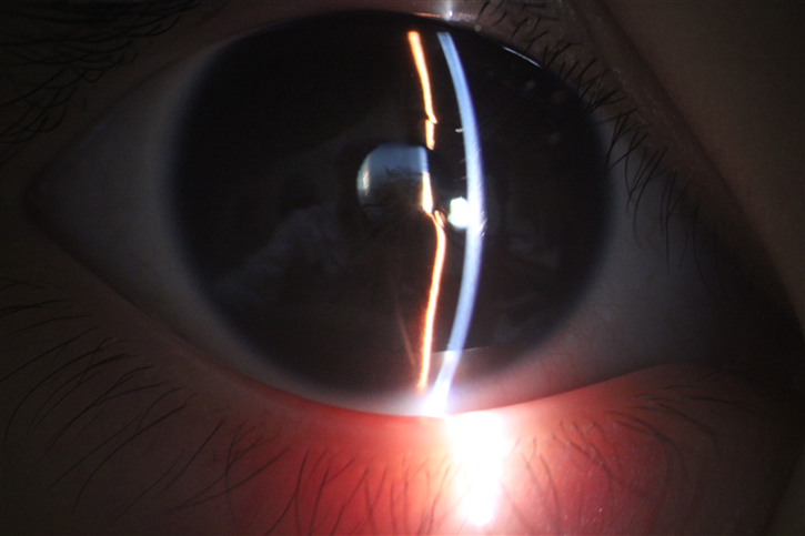 先天性瞳孔残膜一场原生晶体保卫战