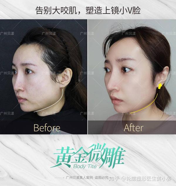 打完瘦脸针多久可以做黄金微雕溶脂呢?