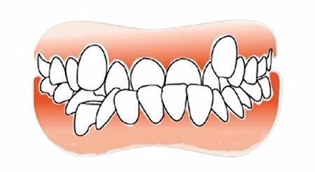 牙齒畸形困擾當代大學生