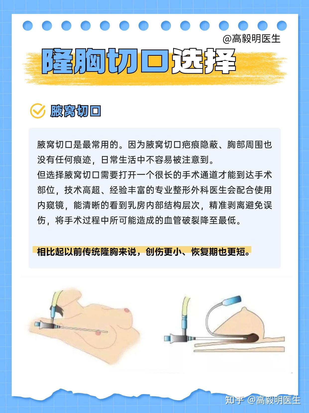 隆胸的三种切口 - 知乎