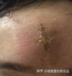 外伤、手术后什么时候能沾水? - 知乎