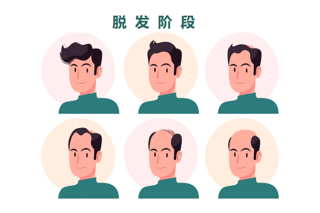 如何判断自己脱发？| 收下这份「生发宝典」，让你告别掉发烦恼！ - 知乎
