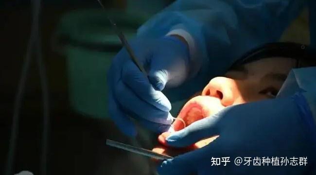 排龈线的选择及排龈方式的设计! - 知乎