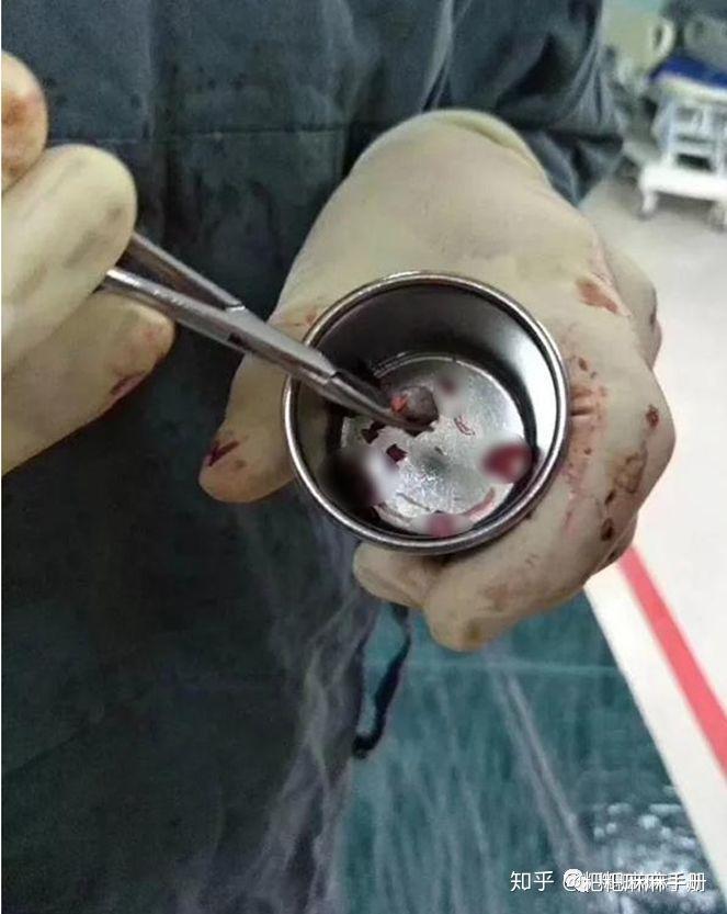 5岁女孩小区玩耍中弹险丧命长辈带娃真没有看上去那么美好