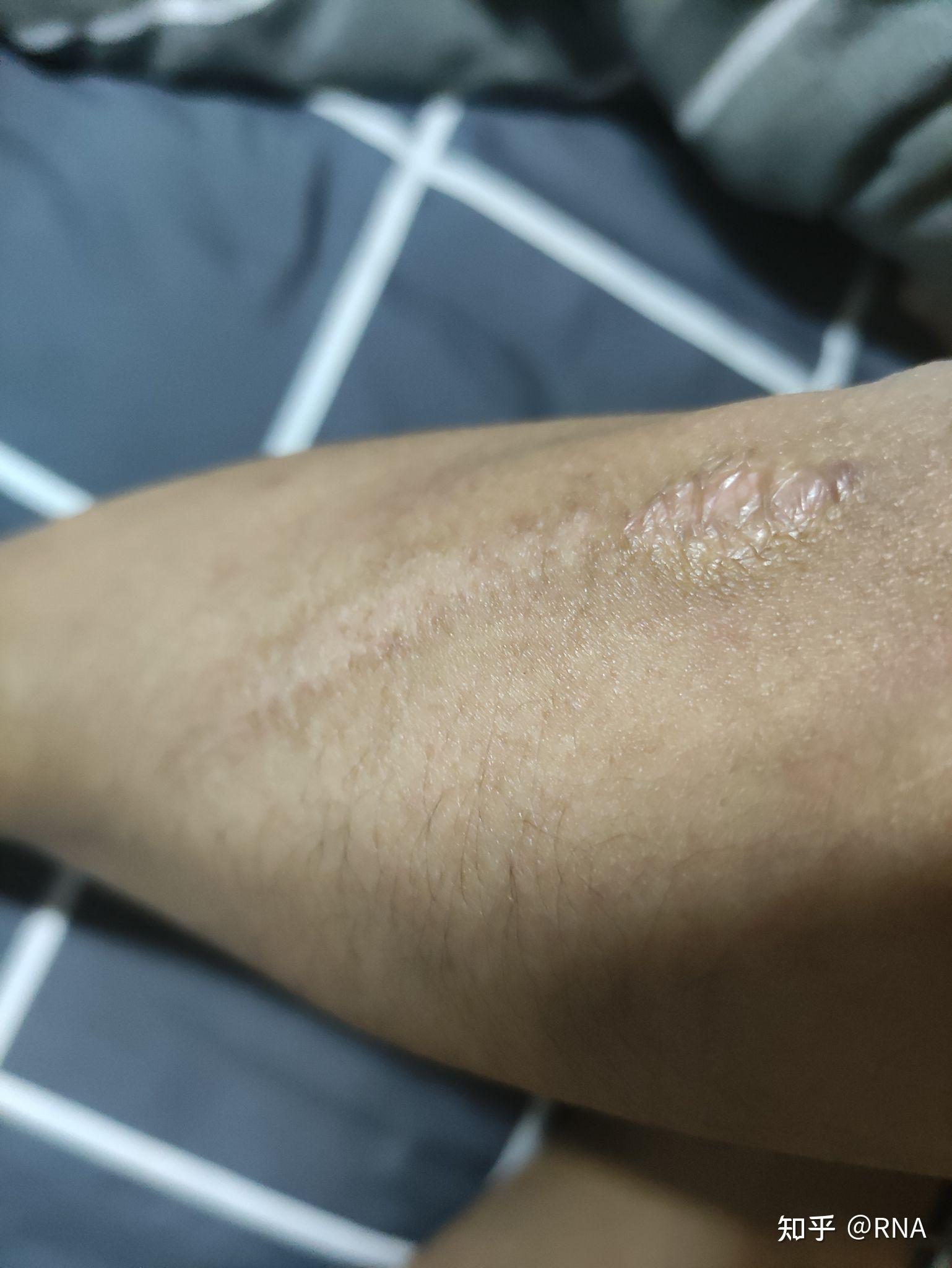 瘢痕体质的瘢痕怎么才能去除疤痕？ - 知乎