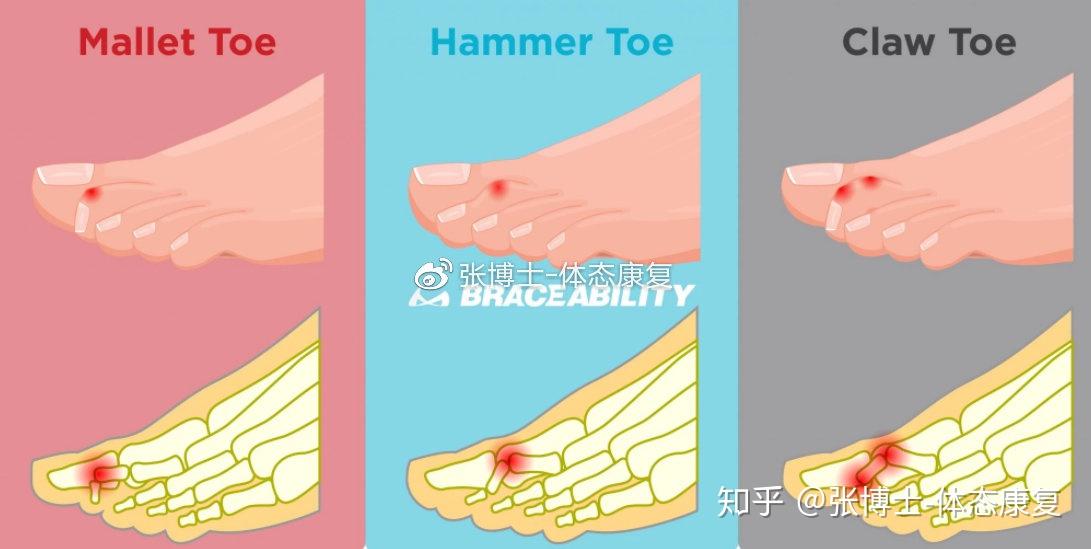 【体态矫正】锤状、爪状、槌状趾是什么?足趾畸形的矫正训练 - 知乎