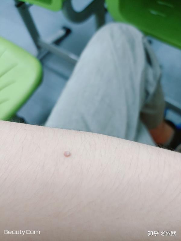 长的这个是什么东西 也不知道是什么 刺瘊? - 知乎