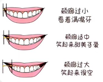 正畸微笑线调整|什么叫微笑线？ - 知乎