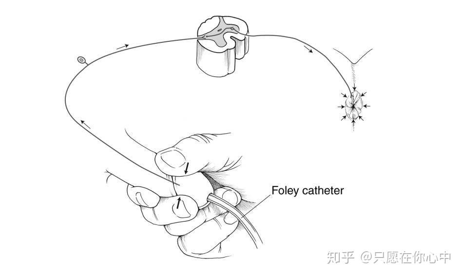 时或轻捏龟头施以少许压力时(女性刺激阴蒂),留置尿管者可牵拉尿管