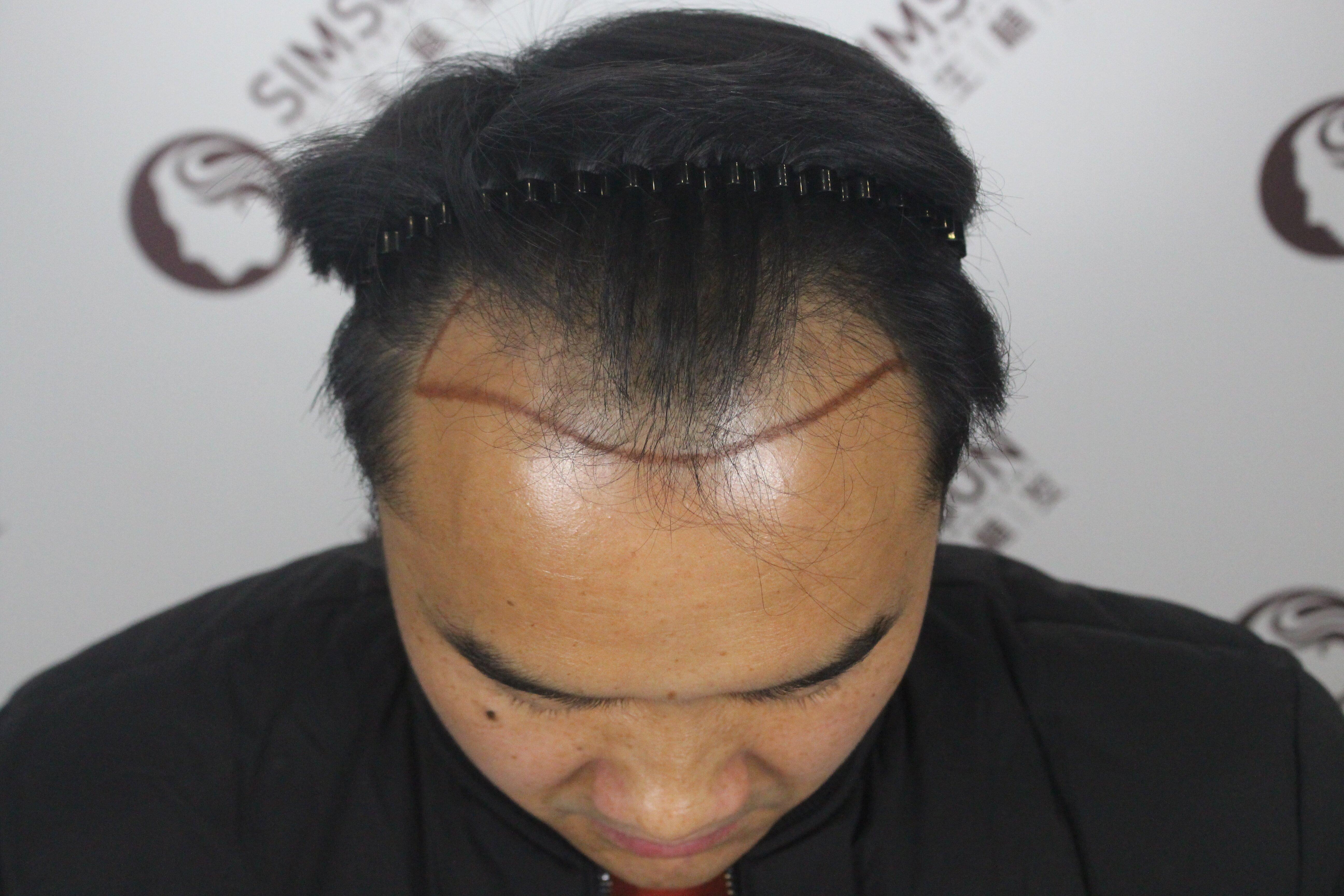 M型脱发严重,植发效果到底有多好? - 知乎