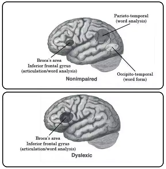 读写障碍探因 - 知乎