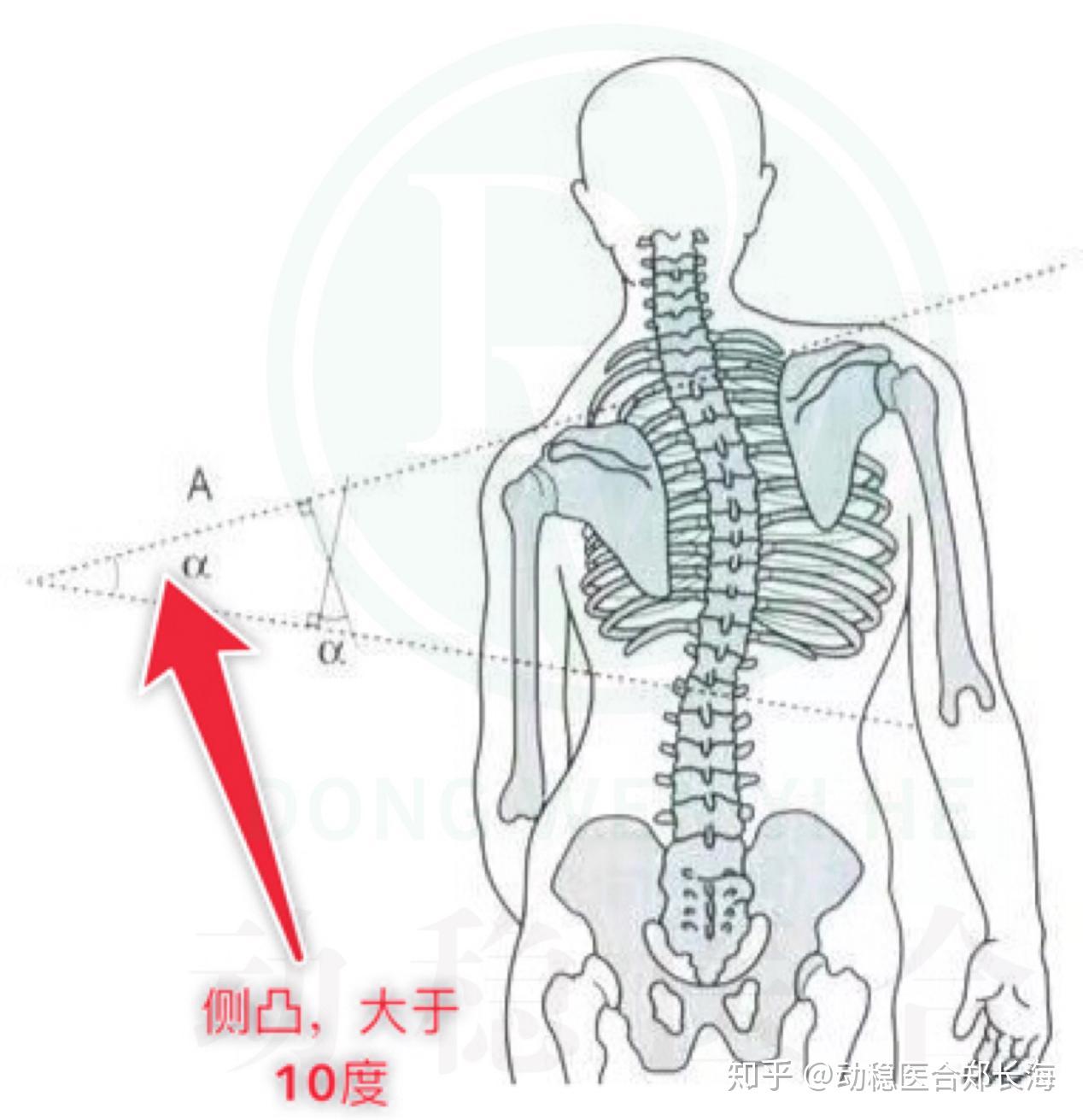 脊柱側彎是指脊柱向一側彎曲,出現一個帶有弧度的畸形.