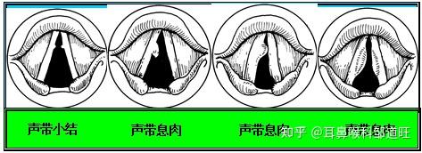 邹道旺医生科普声带小结:声带小结是什么? - 知乎
