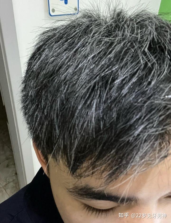 请问有没有解决白发的成功案例? - 知乎