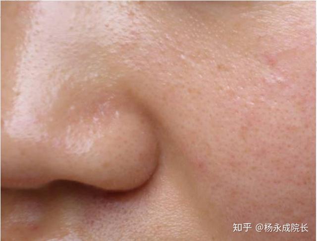 如何护肤2油性皮肤的护理特点