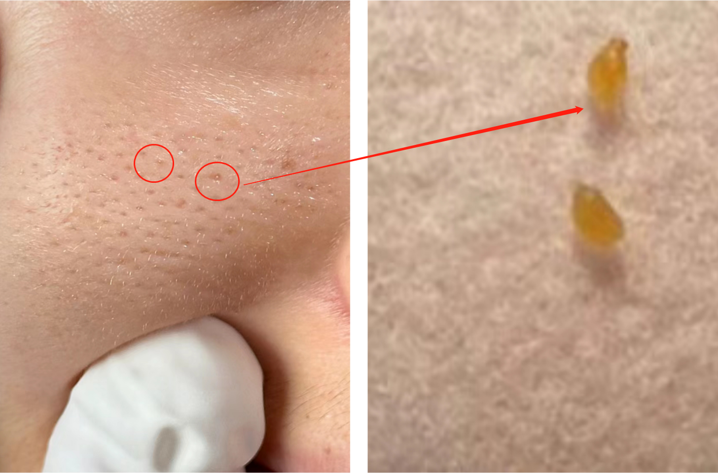 跟着堵在里面,把毛孔撑的越来越大,直至能挤出一粒一粒"黄色"的角质栓