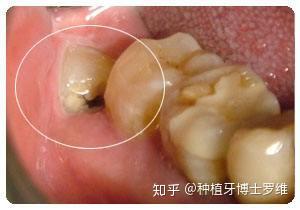 长歪的智齿好拔吗 知乎
