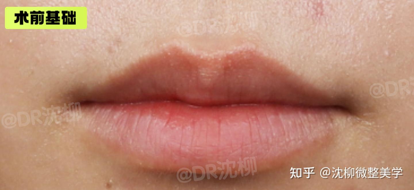靠丰唇可以获得一个完美唇形吗? - 知乎