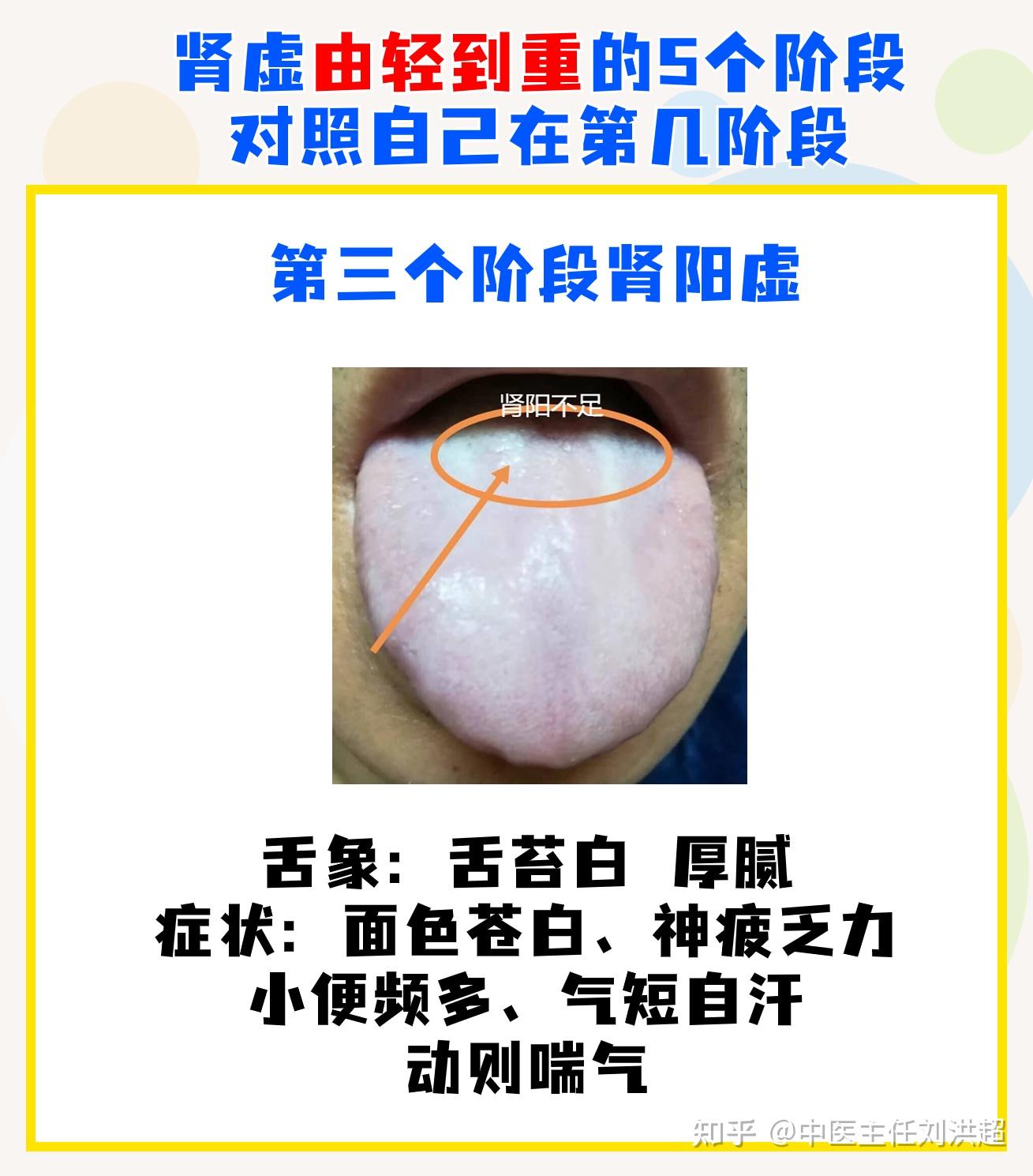 肾虚共有5个发展阶段,舌象及对应表现,对照自己发展到哪一步? - 知乎