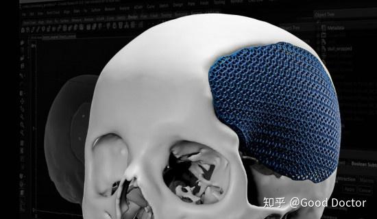 基于mimics进行肺重建的简易流程