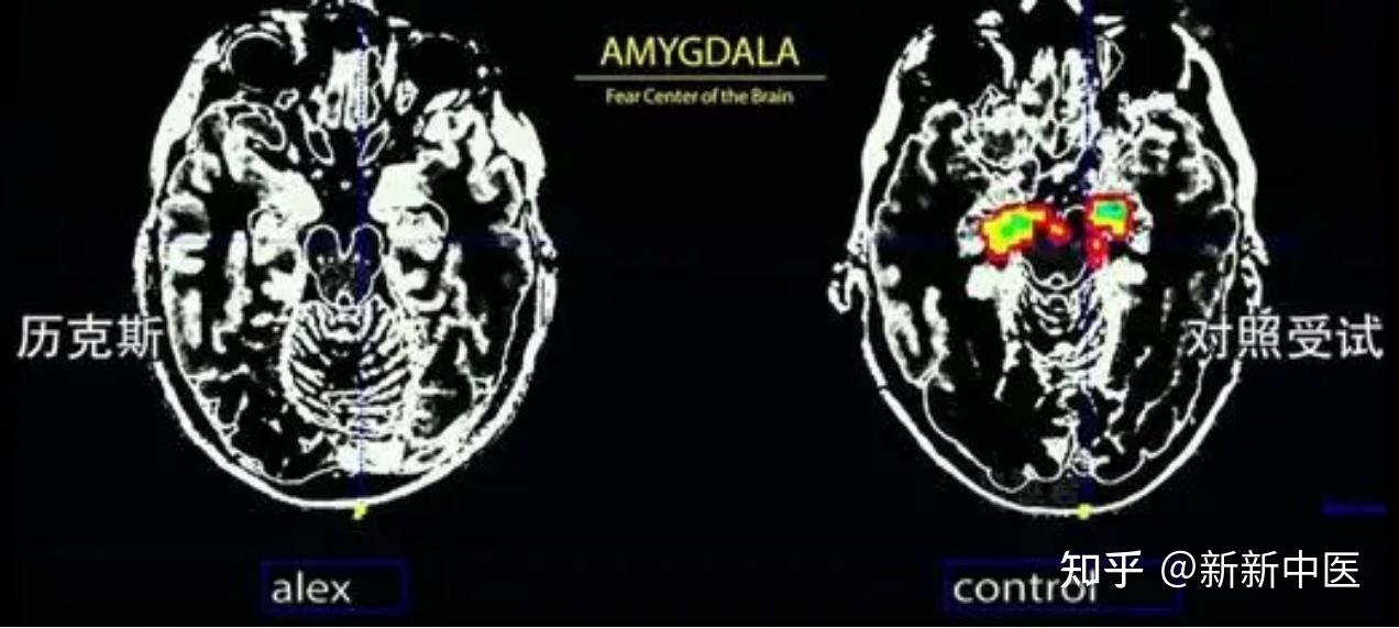 不一样的杏仁核 - 知乎