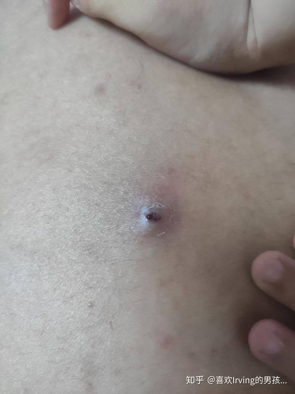 背上挤出黑色像石头一样的东西 后背痘痘挤出黑色硬块 朴乐网