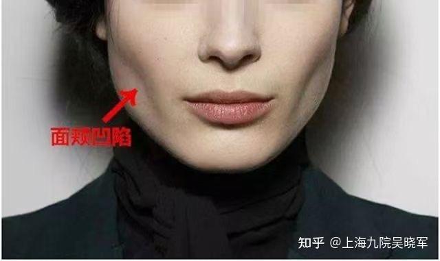 凹陷的面颊该如何改善