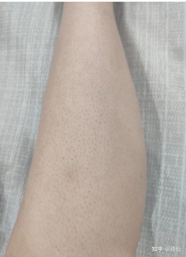 去鸡皮肤穿裙子的鞋子夏天(去鸡皮肤穿裙子的鞋子夏天能穿吗)